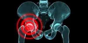 Hip Replacement