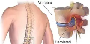 Vertebra